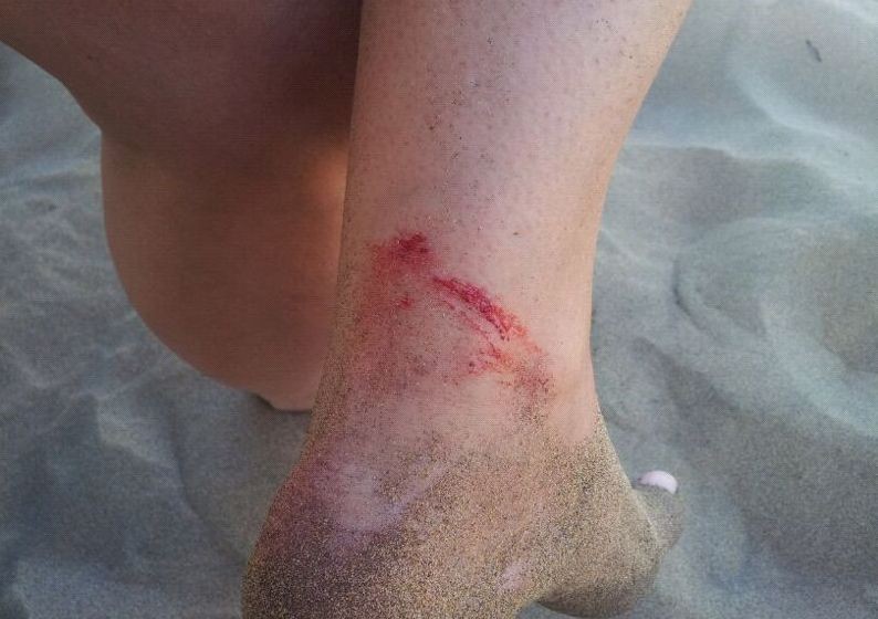 Nueva mordiada de un pez a una turista alemana en playa del Ingl�s