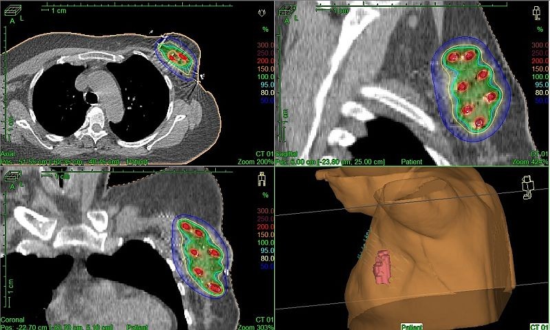 98 de cada 100 mujeres con c�ncer de mama tratadas con braquiterapia, sin reca�da local tras 5 a�os 